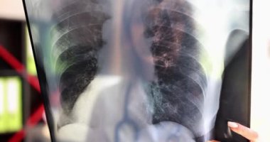 A healthcare provider examines a chest Xray, crucial for accurately diagnosing various lung conditions