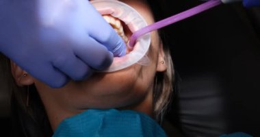 Profesyonel dişçi hastanın dişlerine kaplama takar. Deneyimli bir doktor, hastanın gülümseme estetiğini arttırır. Yavaş çekim