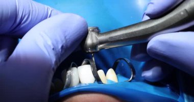 Deneyimli bir dişçi, hastanın dişlerini yüksek hızlı alet çantası kullanarak deliyor. Profesyonel doktor hasarlı dişlerin bir kısmını söker. Yavaş çekim