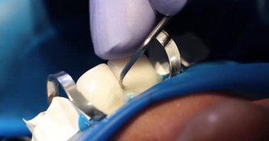 Eylemde tipik bir diş prosedürü sırasında kullanılan çeşitli diş aletlerinin daha yakından ve ayrıntılı görünümü