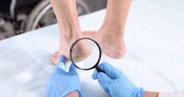 Doktor hastanın topuğunu büyüteçle muayene ediyor. Adam yüksek bir platformda dururken, profesyonel eldivenli adam yayan teninde sorun arıyor.