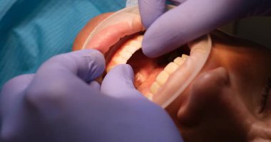 Diş hekimi, klinikte optragate kullanarak diş kaplamasını hastanın dişlerine uyguluyor. Doktor, dişçilik prosedüründe hassas ve rahat bir tedavi uyguluyor.