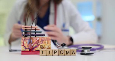 Tahta küplerle ilgili kelime Lipoma, doktor işyerinde deri katmanları modeli. Kadın dermatolog klinikteki yağ dokusundan yapılan iyi huylu tümörü teşhis etti.