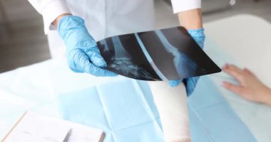 Mavi koruyucu eldivenli bir tıp uzmanı kırık elin röntgen görüntüsünü inceliyor. Hastane ortamındaki kadın hastaya teşhis koymak