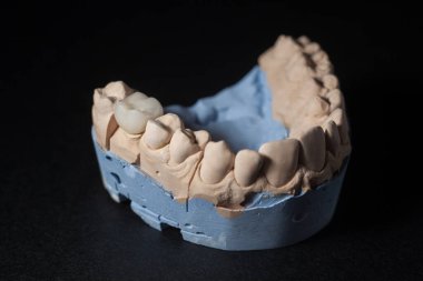 Diş kalıbı. Alçıtaşı model diş sıvası. Stomatolojik alçı kalıpları, insan çenesi kalıpları ve siyah arka planda dişler. Diş ve ortodonti konsepti.