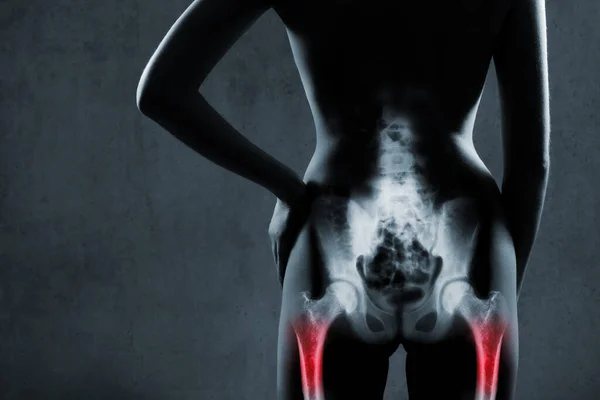 灰色の背景にX線で人間の大腿骨 痛みを伴う女性は赤い色で強調表示されます 女性の痛みを伴う太ももの骨のX線画像 赤地標識の太ももの骨 — ストック写真