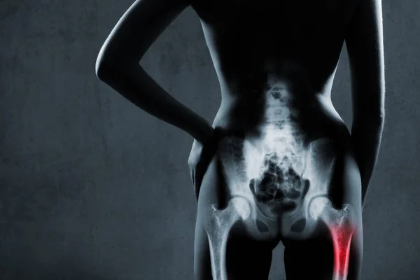 灰色の背景にX線で人間の大腿骨 痛みを伴う大腿骨は赤い色で強調表示されます 女性の痛みを伴う太ももの骨のX線画像 右腿骨の赤い部分のマーク — ストック写真