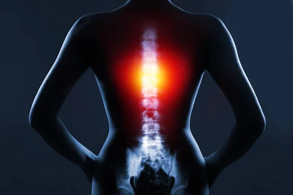 Menselijke Wervelkolom Röntgenfoto Blauwe Achtergrond Borst Wervelkolom Gemarkeerd Door Rood — Stockfoto