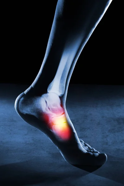 人的脚脚踝和腿在蓝色背景的X光下 脚脚踝被红黄相间的颜色所衬托 — 图库照片