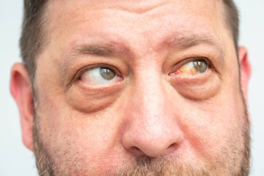 Bir adamın yüzüne yakın çekim: gözle görülür kanama ve göz kızarıklığı, kılcal yırtılma veya enfeksiyonun olası sonuçları.