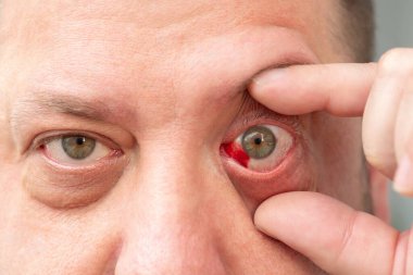 Hemorrhage due to capillary rupture in the man's eye. Detailed image of a man's face with a reddened eye. clipart