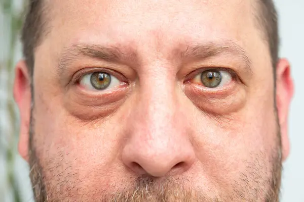 Close Rosto Homem Hemorragia Visível Vermelhidão Olho Possíveis Consequências Ruptura Imagem De Stock