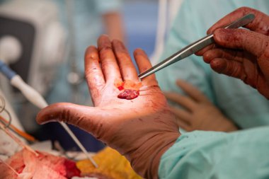 Doktor, ameliyat sırasında çıkardığı kanserli tümörü gösteriyor. Onkolojiyi çıkarmak için ameliyat. Gerçek ameliyathane. Yüksek kalite fotoğraf