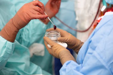 Doktor, ameliyat sırasında çıkardığı kanserli tümörü gösteriyor. Onkolojiyi çıkarmak için ameliyat. Gerçek ameliyathane. Yüksek kalite fotoğraf