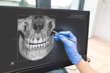 Dişçi bir hastanın dişlerini incelemek için bilgisayar monitörü kullanıyor. Monitörde hastanın dişlerinin ve diş etlerinin 3 boyutlu görüntüsü var..