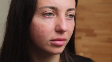 Yanaklarında kızarıklık olan genç bir kadın yüzü, yakın plan. Deri sorunları, sivilceli, sağlıksız bir cilt. Alerjik kızarıklıklar. Sorunlu cilt bakımı kavramı