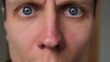 Adam parmaklarıyla kırmızı sivilceye basıyor. Yüzünde iltihap var. Dermatoloğa git. Burun üstü sivilce. Yüzünde sivilceler. Yakın plan.