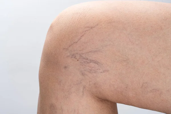 Варикозные Вены Женской Ноге — стоковое фото