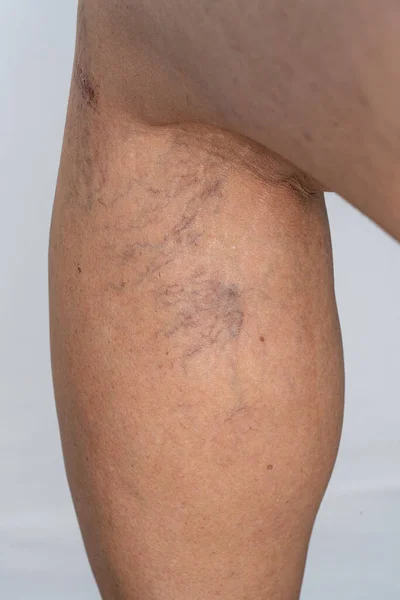 Κιρσώδεις Φλέβες Στο Γυναικείο Πόδι — Φωτογραφία Αρχείου