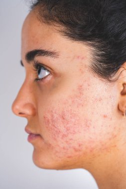 Genç kızın yüzünde sivilce var. Genç kızda sivilce