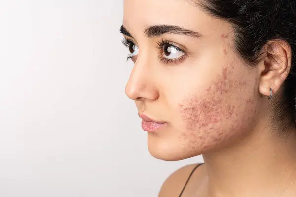 Acne on the young girl\'s face. Acne in teenage girl