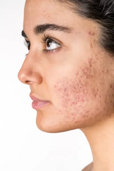 Acne on the young girl\'s face. Acne in teenage girl