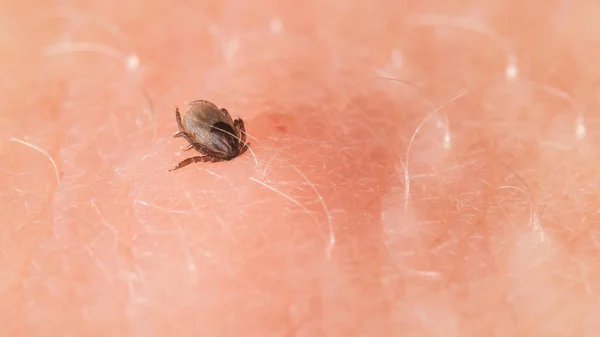 Parasitic deer tick bitten in a human skin at sucking blood. Ixodes ricinus or scapularis. Closeup of dangerous insect mite on pink background of epidermis with light hairs. Tick-borne diseases carrier.