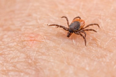 İnsan derisini ısırmanın tehlikeli bir paraziti olan Castor fasulyesi kenesi. Ixodes ricinus veya skapularis. Pembe deride böcek maytlarının yakınlaşması. Kene kaynaklı hastalıkların enfekte parazitle bulaşması tehlikesi.