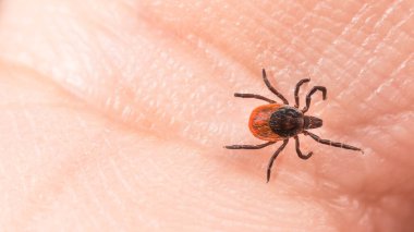 İnsan derisi dokusunda dişi hintyağı kenesi. Ixodes ricinus veya skapularis. Parazit böcek maytı, ensefalit enfeksiyonu taşıyıcısı. Kene kaynaklı hastalıklar bulaşma tehlikesi.