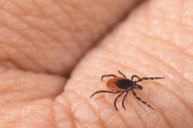 İnsan parmaklarında sürünen dişi geyik kenesi paraziti. Ixodes ricinus. Parazit böcek maytlarına yakın çekim. Ensefalit ve Lyme borreliosis olarak kene kaynaklı hastalıkların bulaşma tehlikesi.