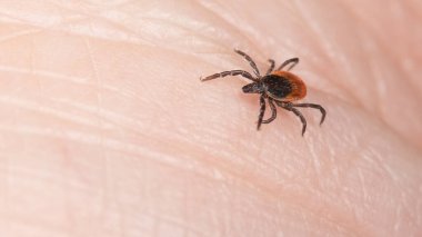 İnsan derisi üzerinde tehlikeli bir geyik kenesi paraziti. Ixodes ricinus veya skapularis. Lyme Borreliosis ya da beyin iltihabı gibi mide bulandırıcı parazit, kene kaynaklı hastalık taşıyan böcek taşıyıcılarına yakın çekim.