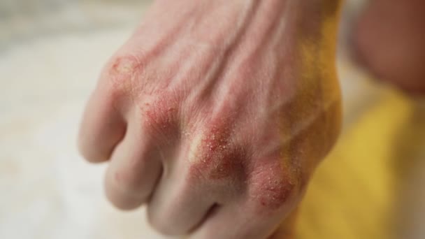 Close Mans Hand Dry Cracked Bloody Skin Chapping Skin Winter — Stock Video
