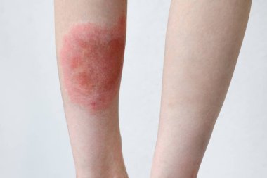 Close-up of a person's leg with erythema after a tick bite, showing a red rash clipart