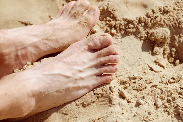 stock image Close-up of feet buried in sand at the beach, highlighting toes with a fusion deformity, depicting relaxation, beach activities, and unique physical traits. Webbed toes- birth defect, syndactyly.