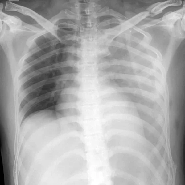Radiographie Thoracique Homme Ans Victime Accident Route Révélant Des Fractures — Photo