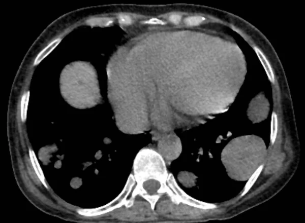 Yaşında Nefes Darlığı Çeken Bir Kadının Göğüs Tomografisi Taraması Akciğerlerde — Stok fotoğraf