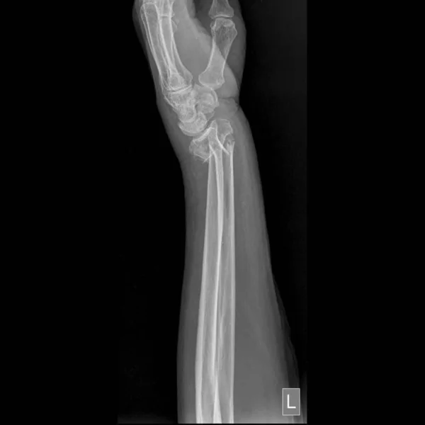 Ray Colles Fracture Fracture Radius Lower Arm Bone Wrist Posterior — Stock Photo, Image