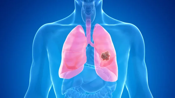 Καρκίνος Του Πνεύμονα Μπλε Φόντο Εικονογράφηση — Φωτογραφία Αρχείου