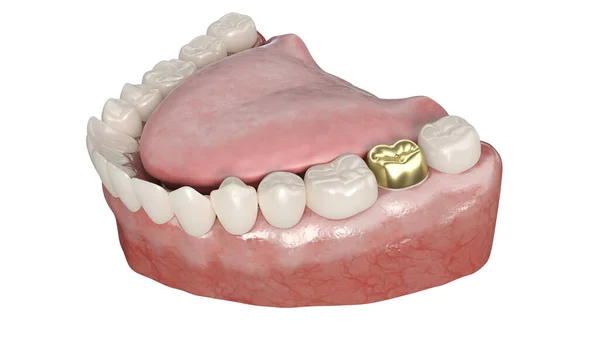 Стоматологічна Коронка Ізольована Білому Тлі Ілюстрація — стокове фото