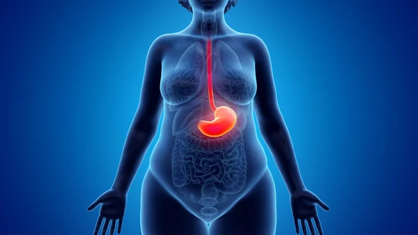 肥満の女性の胃 イラスト — ストック写真