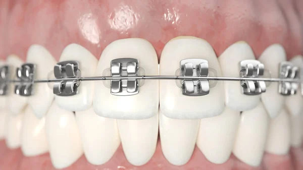 Braces Dentaires Isolées Sur Fond Blanc Illustration — Photo