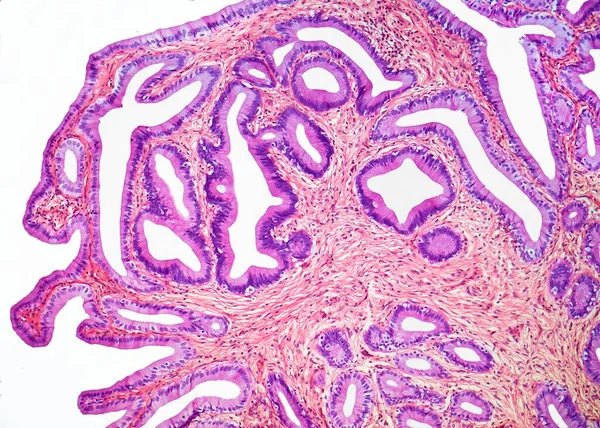 Colecistitis Micrografía Ligera Una Sección Través Una Vesícula Biliar Con — Foto de Stock