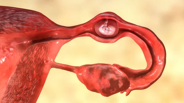Embarazo Ectópico Ilustración Embrión Implantado Trompa Falopio Útero — Foto de Stock