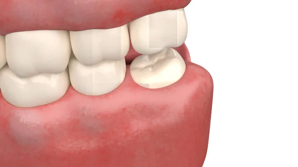 Sabedoria Impactada Dente Ilustração — Fotografia de Stock