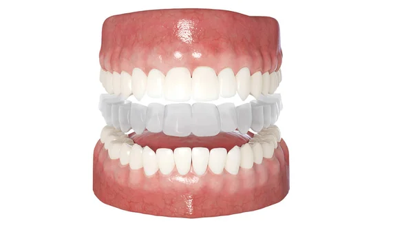 Alineador Dental Claro Ilustración — Foto de Stock