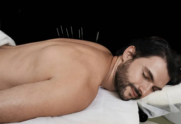 Mann Mit Akupunkturnadeln Rücken — Stockfoto