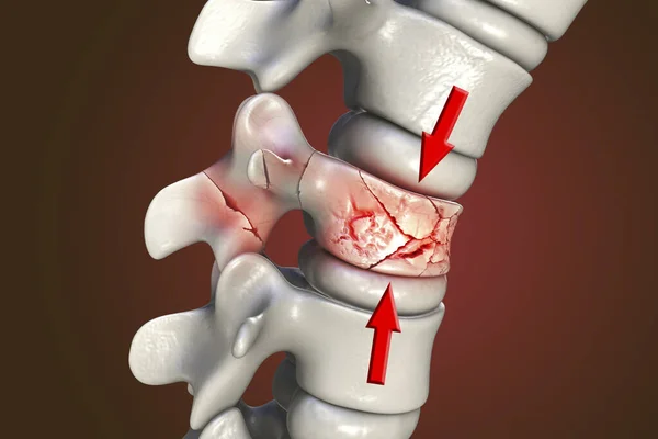脊髓压迫性骨折 计算机图解显示一个椎体 骨头块 的压缩骨折 红色裂缝 每一个椎间盘之间都有纤维软骨的圆盘 脊柱的前部在里格 — 图库照片