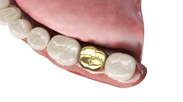 Zubní Koruna Izolovaná Bílém Pozadí Ilustrace — Stock fotografie