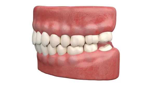 Sabedoria Impactada Dente Ilustração — Fotografia de Stock