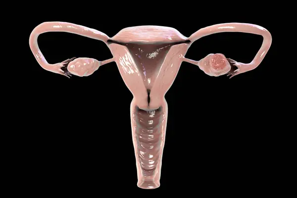 Ovarian Cancer Computer Illustration Showing Malignant Tumour Left Ovary Cancer — Stock Photo, Image